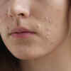 Try salicylic acid