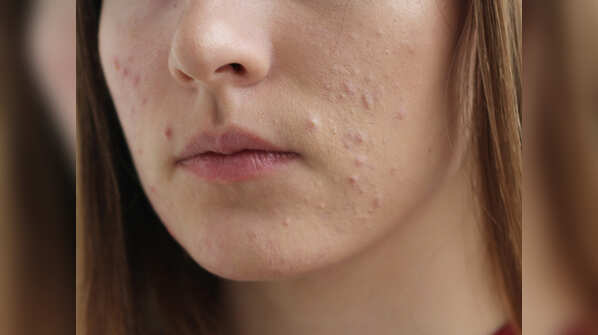 Try salicylic acid