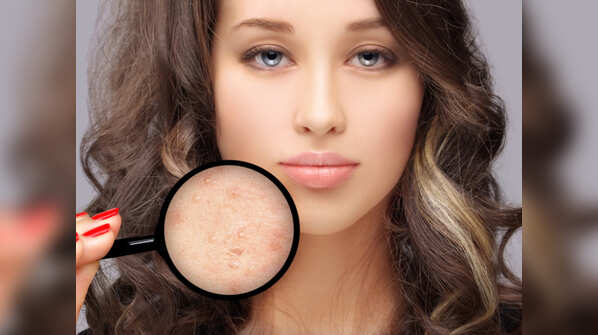 What is a blind pimple?