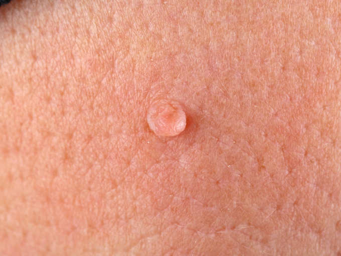 warts on skin how to remove