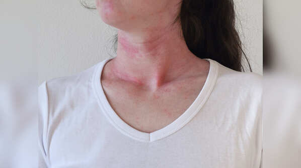 Anti- allergic