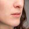 Cracks at the corner of the mouth