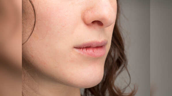 Cracks at the corner of the mouth