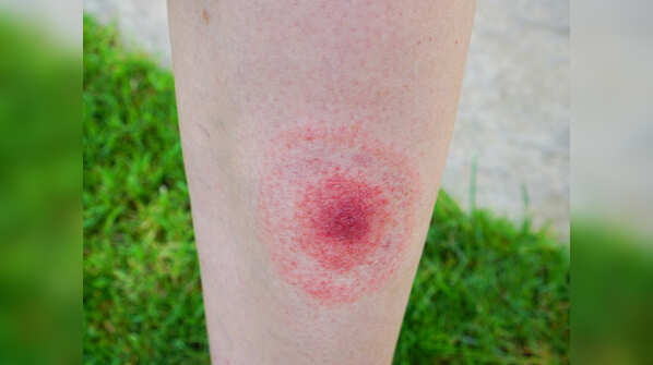 Lyme disease