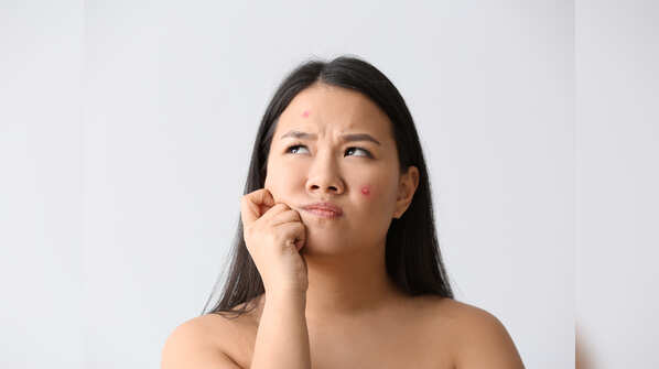 Fight acne