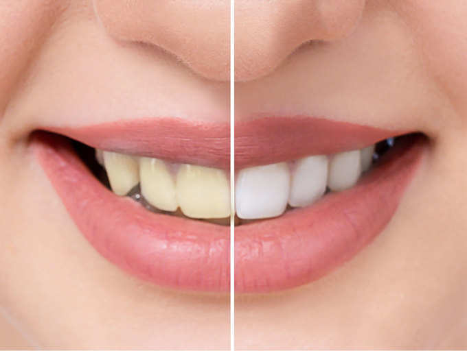How to whiten your teeth with common kitchen ingredients | The Times of  India