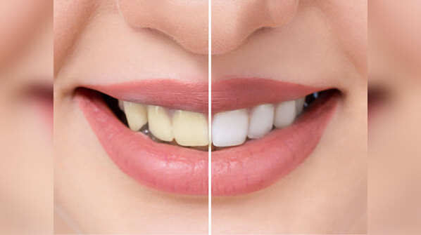 How to get rid of yellow teeth