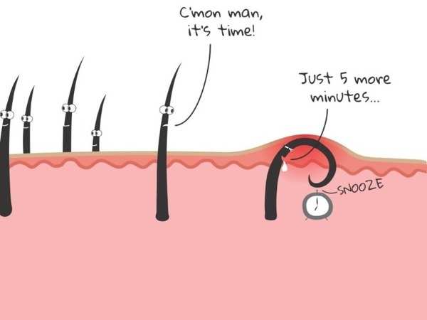 Ingrown Hair Removal: Here's How You Can Get Rid Of Ingrown Hair