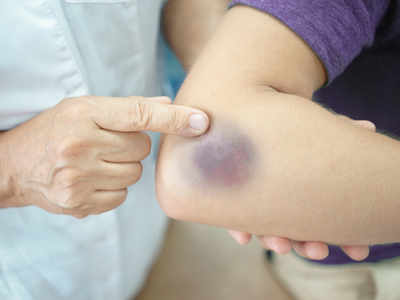 Bruise Home Remedies or Treatments: How to at Home