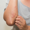 ​Prolonged body rash