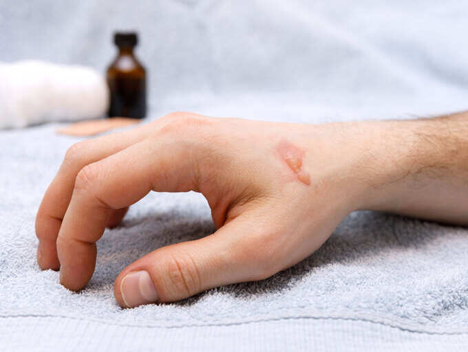 Best Skin Burns to Avoid