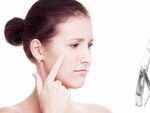 Rosacea