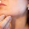 Cure acne
