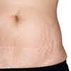 ​How to deal with stretch marks