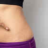 ​How can you prevent stretch marks while losing weight?