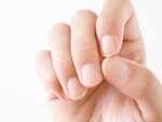 Brittle nails