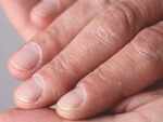 Clubbing nails