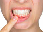 You have inflamed gums