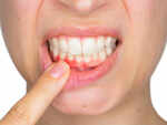 You have inflamed gums