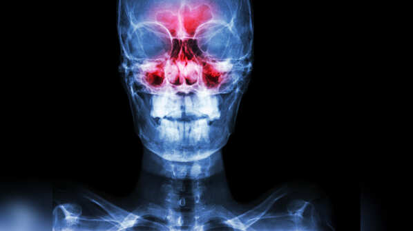 What is sinusitis?