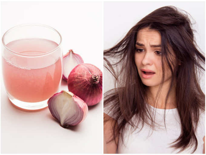 can onion juice cause hair loss