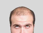 You suffer from hair loss