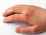 ​Heals burns and wounds