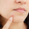 ​The link between food and acne
