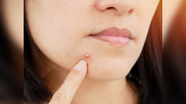 The link between food and acne