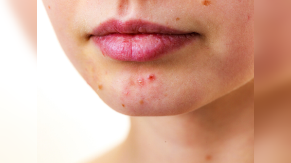 Stop eating these three food items to get rid of acne