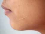 Can prevent the formation of scars