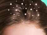 Can cause dandruff