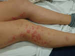Rashes on the legs