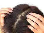 Your scalp can get really itchy