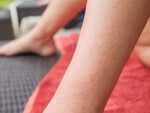 What kind of rashes are seen?