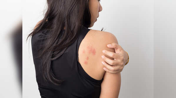 Rash, hives or chicken pox-like lesions