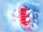 ​Causes of colon cancer