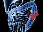 ​Symptoms of colon cancer