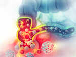​​Colon cancer