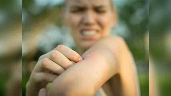 Keep your hands off of bug bites, blackheads and injuries