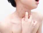 Skin rashes