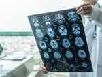 Study: Signs of brain damage in COVID-infected patients