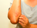 Are adverse reactions possible? How many have taken place in India?