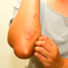 Are adverse reactions possible? How many have taken place in India?