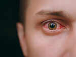 ​Pink eye