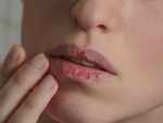 Dry mouth