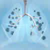 ​Lungs infection