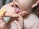 Irregular skin rashes