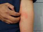 Skin rashes, COVID nails and toes