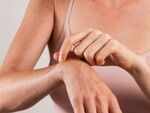 What causes Beau's lines to appear?